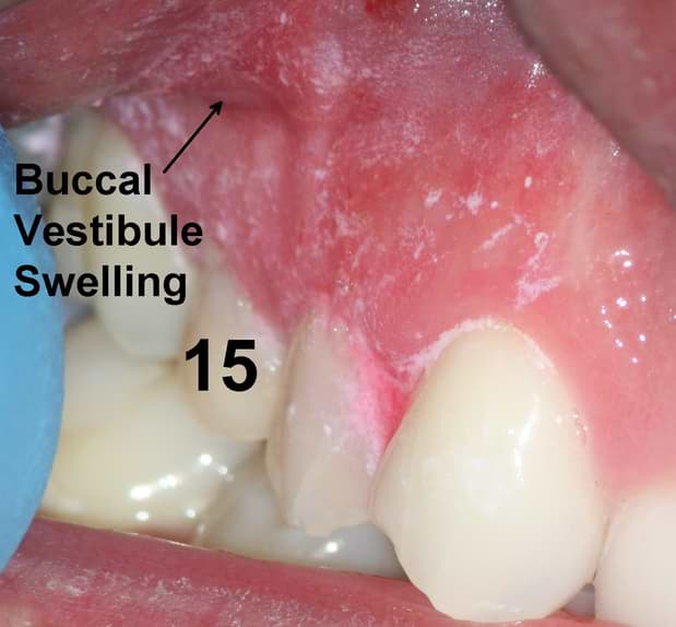 ENDO NEWSLETTER JANUARY 2020 Storytime... MD Mal Diagnosis... BC